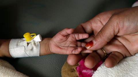 Die Hand einer Frau hält die Hand eines unterernährten Kindes. (picture alliance/dpa/XinHua)