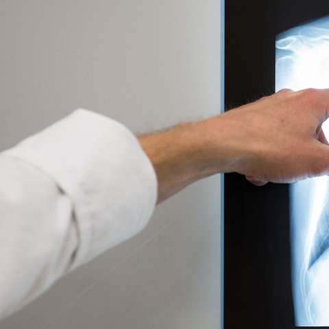 Ein Arzt zeigt auf das Röntgenbild einer Lunge. (Archivbild: 02.03.2017)  (dpa)